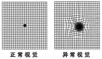 正常眼底黄斑oct图片 正常眼底oct报告图片数值 