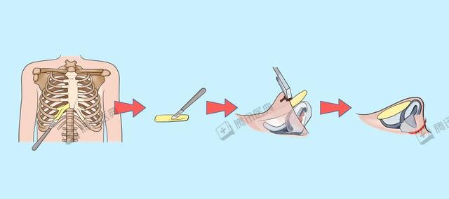 关于隆鼻的五个小常识，千万要注意避免这5个坑