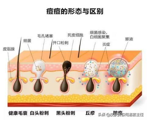 结节性痤疮图片，痤疮的不同形态（痤疮是怎么引起的）