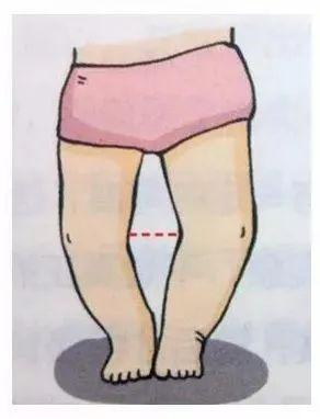 "罗圈腿"该怎么纠正?