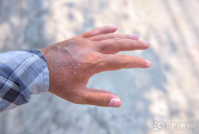 手上起小水泡痒怎么办，长了透明的小水泡一样的是什么（手上经常起水泡，还痒得不行）