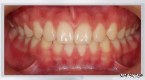 牙齿的种类有哪些，牙齿有哪些分类（带你了解人类牙齿的进化史）