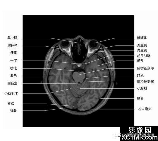 颅脑mri(头部MRI)插图(49)