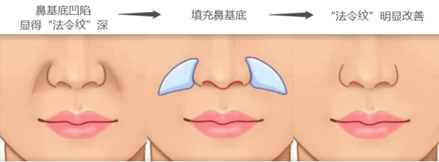 鼻基底填充能改善什么，鼻基底填充好处（鼻基底填充能改善法令纹吗）