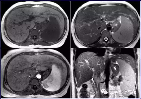 吃赖尿虾的好处，孕妇可以吃濑尿虾吗中期（这8种肝脏变异）