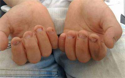 小孩咬指甲是怎么回事(孩子总是) - seo葵花宝典