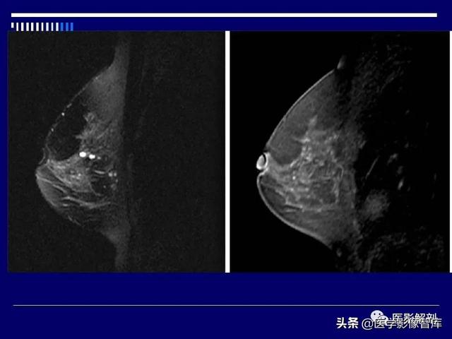 乳房解剖学基础知识，乳腺解剖及乳腺各病变影像诊断与鉴别