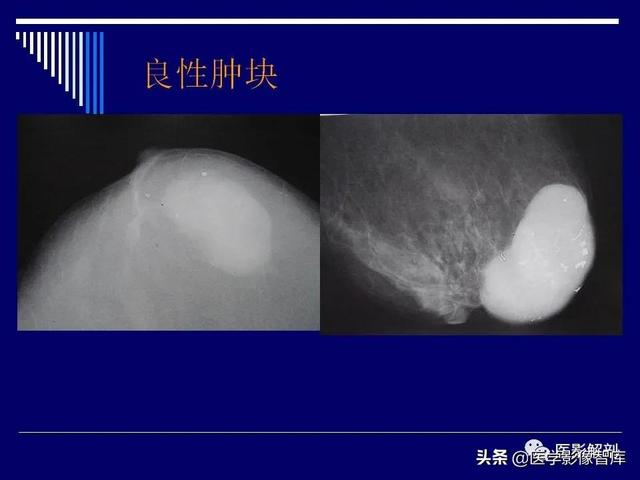 乳房解剖学基础知识，乳腺解剖及乳腺各病变影像诊断与鉴别