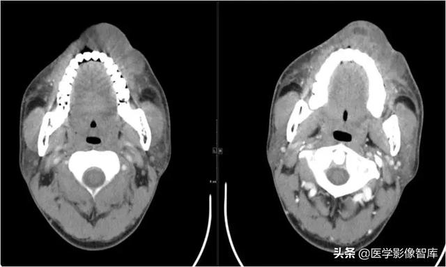 颞间隙感染，颞间隙感染切开部位（颌面部间隙感染影像诊断及各间隙解剖介绍）