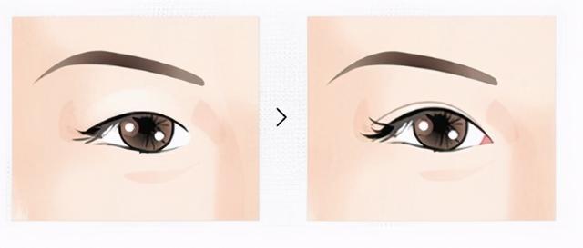 开眼角成功率高吗，开眼角成功率高不高（眼角不是你想开，想开就能开）