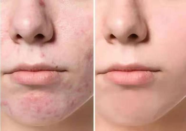 激光去痘印原理，激光去痘印什么原理（<坑>想做点阵激光效果如何）