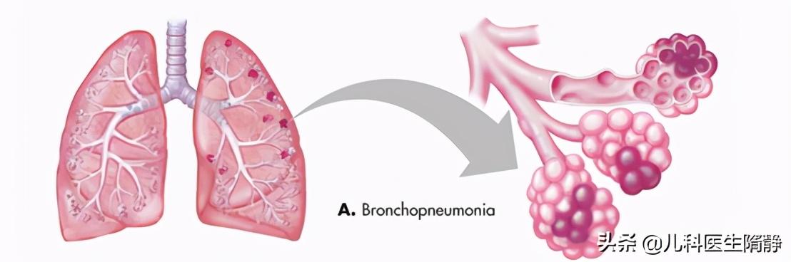 小儿支气管肺炎怎么引起的(小儿支气管肺炎如何治疗)