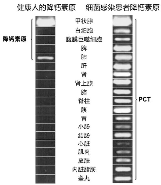 路亚pe线用几号最合适，路亚用几号pe线合适（降钙素原检测如何指导临床决策、预估甚至降低死亡风险）