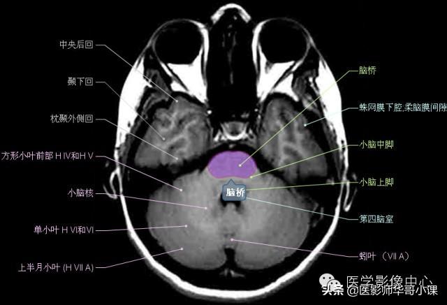 颅脑mri(头部MRI)插图(36)