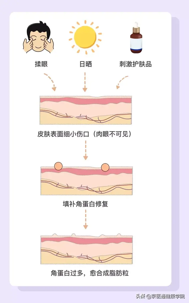 几种常见疣体图片，十二种疣体图片（粟丘疹、汗管瘤、扁平疣哪种才是脂肪粒）