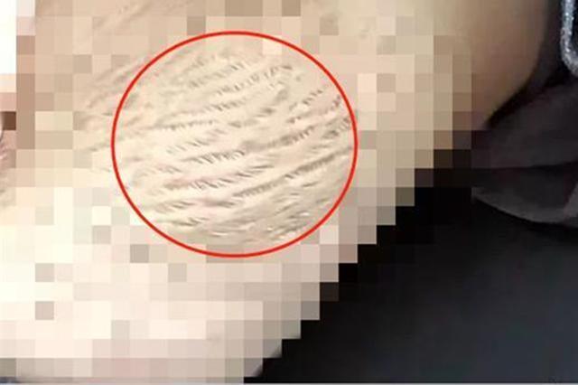 23岁女子生4个娃晒妊娠纹惊呆网友，妊娠纹能消除吗，23岁女子生4个娃晒妊娠纹惊呆网友（23岁女孩生四个孩子）