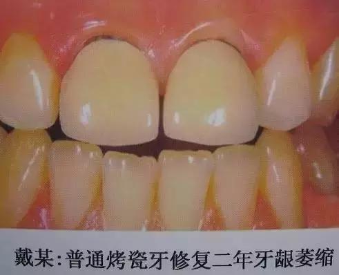 烤瓷牙是怎么做的，烤瓷牙是怎么做的伤牙吗（牙医教你如何选择烤瓷牙的材料）