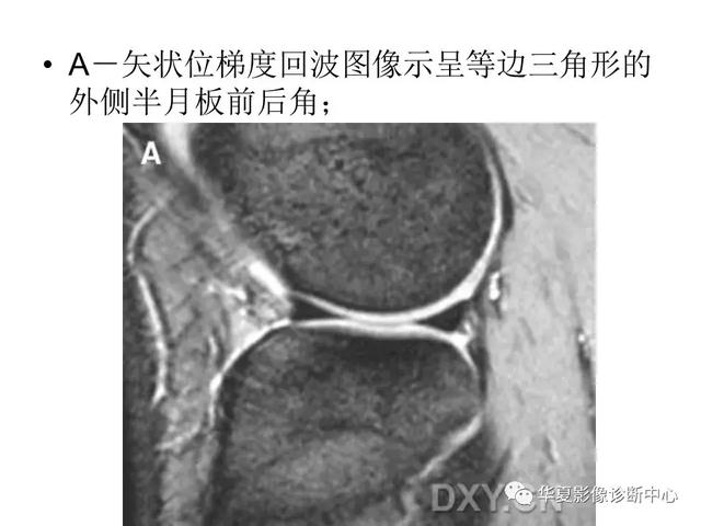 膝关节解剖结构图，膝盖解剖图示意图（膝关节MRI之正常解剖综述）