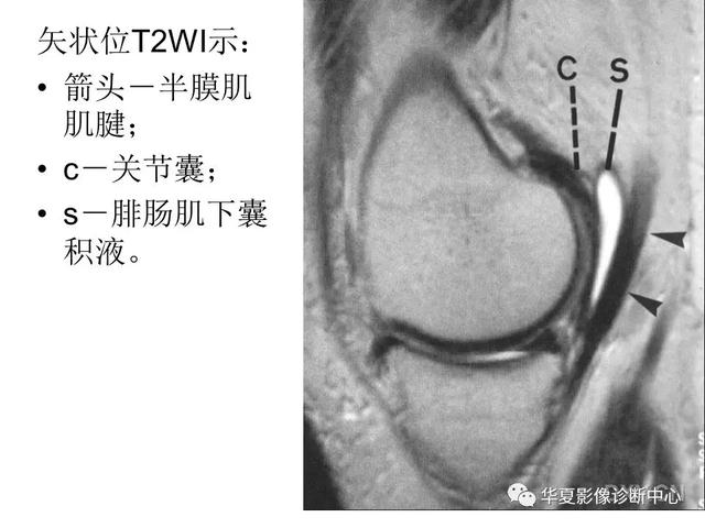 膝关节解剖结构图，膝盖解剖图示意图（膝关节MRI之正常解剖综述）