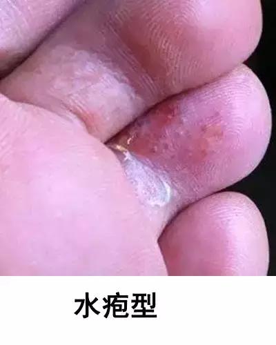 得了脚气就是一辈子吗，有脚气的原因（夏季脚气反复、恶痒难忍怎么办）