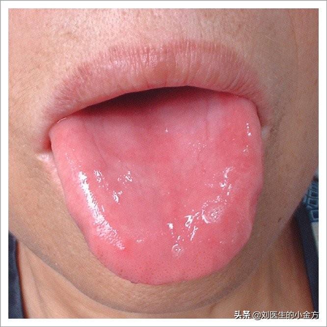 中医质舌诊图种【舌象特征】舌色红,舌诊属于舌苔少或舌红少津剥苔,大