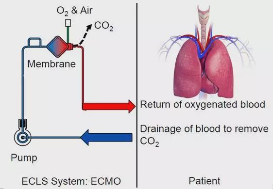 什么是ecmo设备，中国有多少ecmo设备（可以从阎王手里抢人的ECMO是什么）