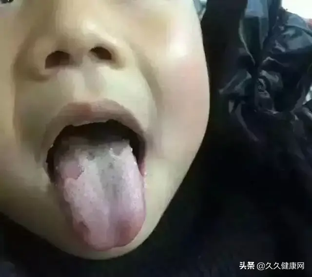 婴儿舌苔厚黄能自愈吗，婴儿舌苔黄的治疗方法（宝宝舌苔厚、发黄、发黑、发红等现象是怎么回事）