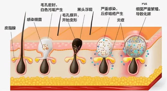 消除皱纹的10个最好最简单方法，消除皱纹的10个最简单方法（消除的最简单的方法是什么）