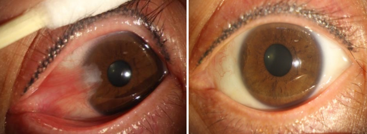 翼状胬肉手术多少钱(六旬老人眼睛里长出) - 价格百科