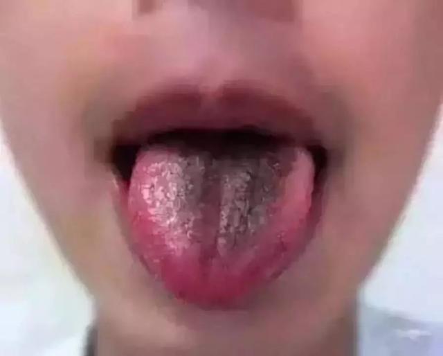 健康的舌头图片，如何判断自己的舌头健康状况（五脏在舌头均有反射区）
