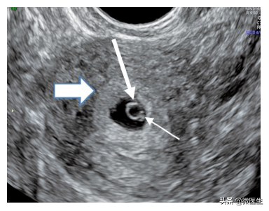 双环征是什么意思，可见双环征是什么意思（让孕妈头大的孕期B超图怎么看）