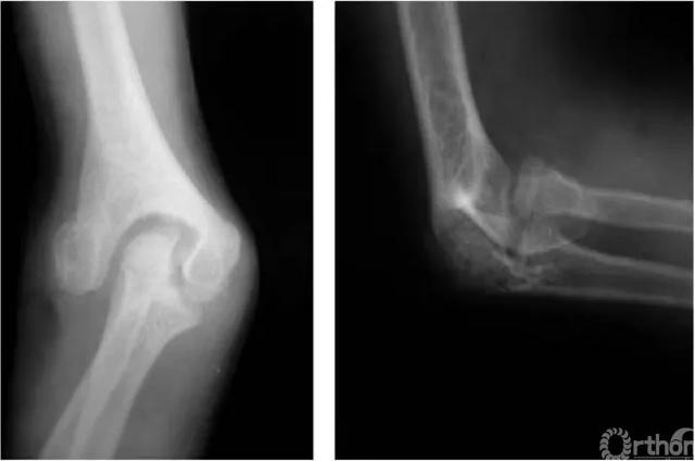 肱骨长是什么意思，骨科常见疾病X线解析之肱骨内髁骨折