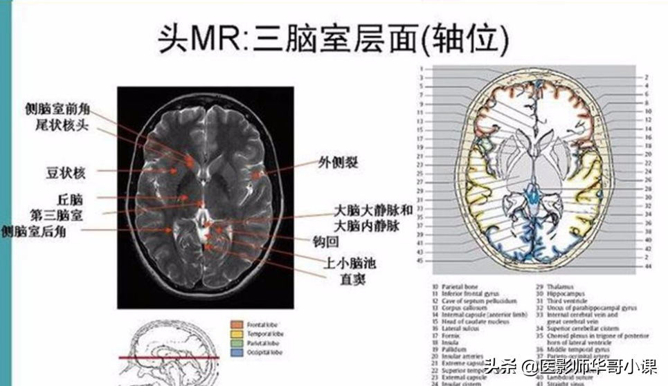 颅脑mri(头部MRI)插图(72)