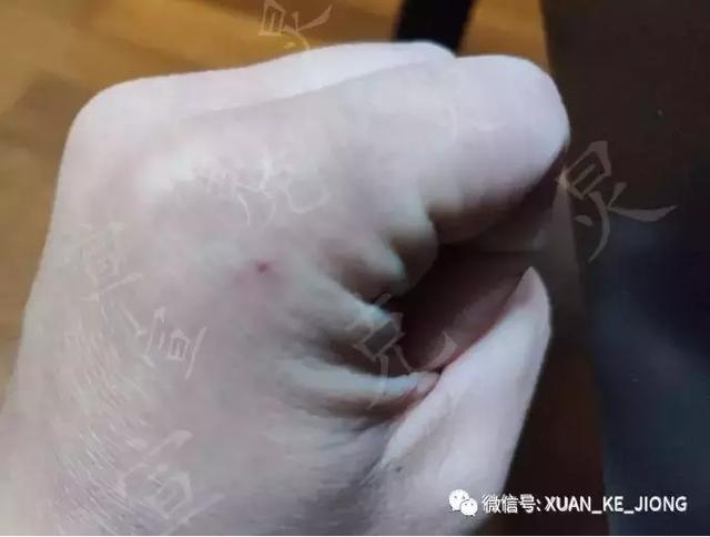 为什么被魟螫后会中毒，被毒蛇咬了会被毒死吗（我被一条魟鱼给刺伤了）