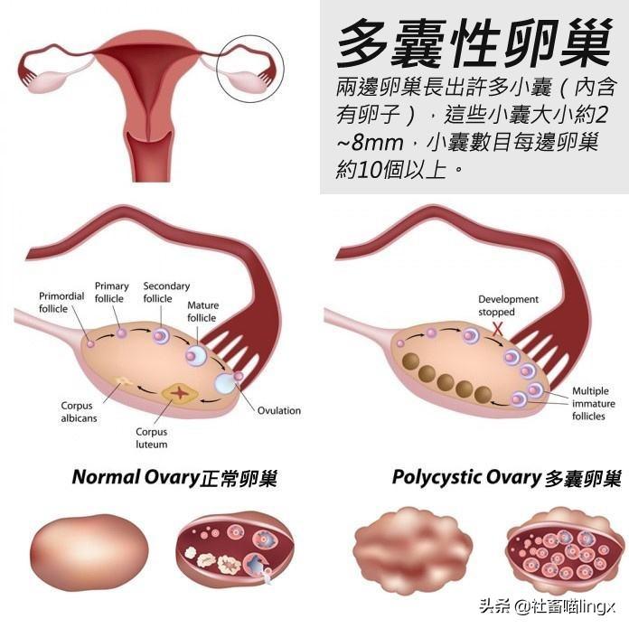 多囊卵巢綜合徵因排卵功能異常易導致患者不孕,多囊卵巢綜合徵也是