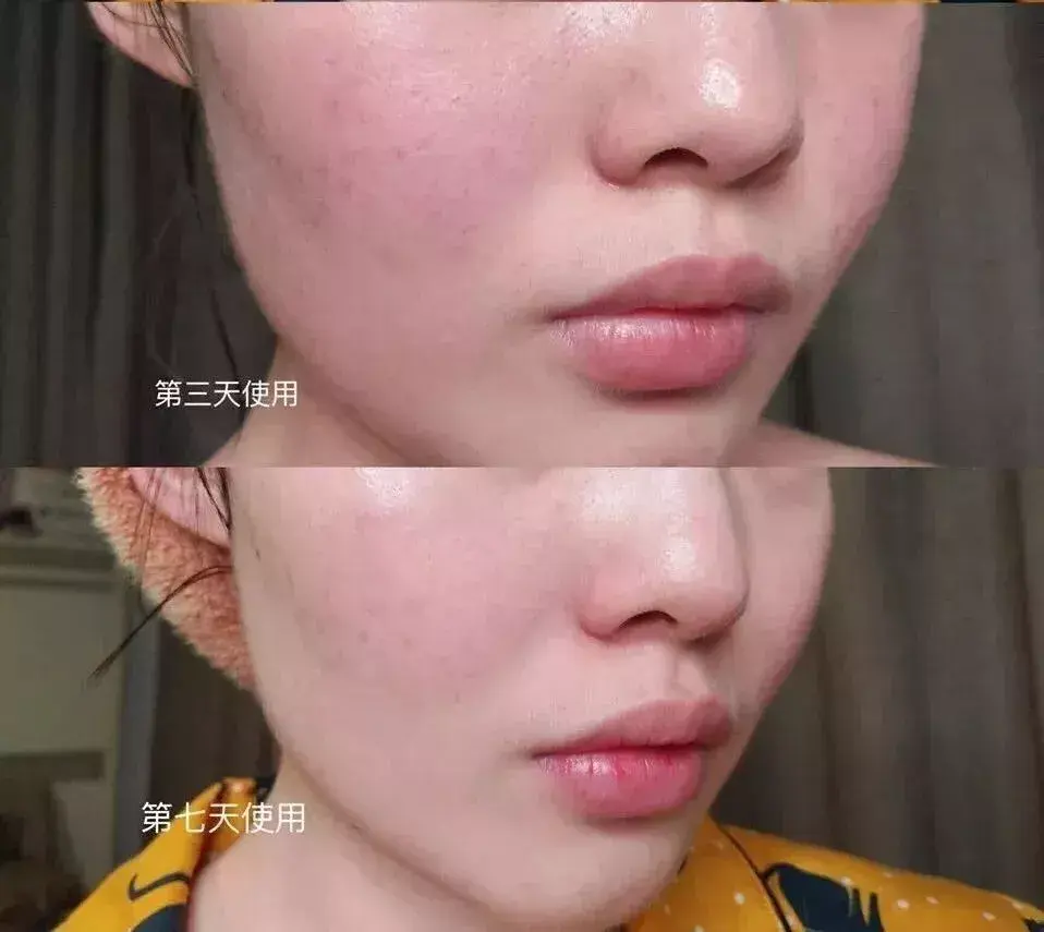 敷尔佳面膜(保湿面膜哪个牌子最好)