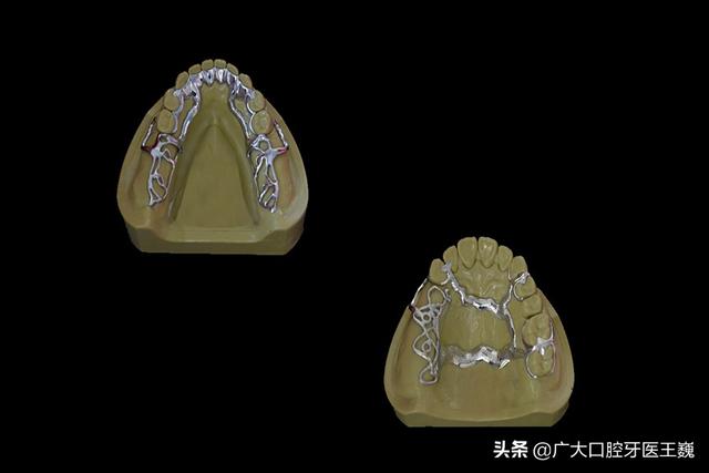 怎么样种牙，怎么样种香菜（目前最先进的活动义齿是哪种）