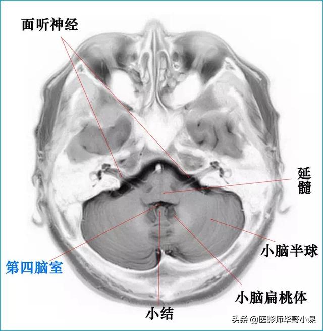 头颅ct解剖图，头部骨骼结构图（颅脑磁共振MRI解剖结构以及高清图谱）