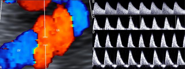 sga是什么意思，毁人之国而非久也的久是什么意思（胎儿超声多普勒检查应用2）
