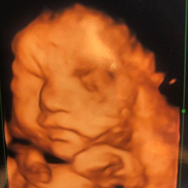 光敏印章怎么加油，原子公章和光敏章的区别（萌娃因“蝙蝠侠”胎记遭网暴）