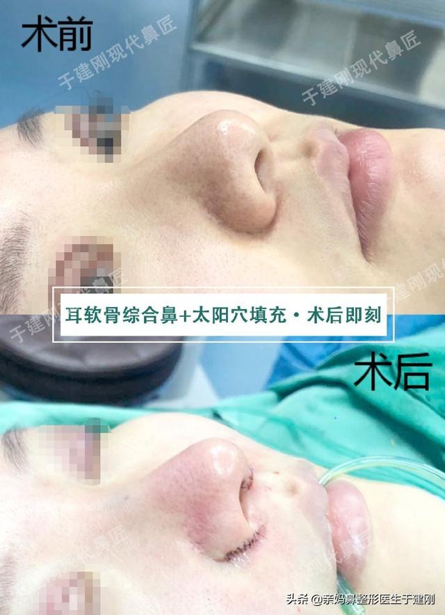 一张图看懂鼻基底凹陷对比图，塌鼻秒变立体质感鼻