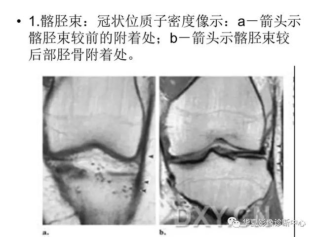 膝关节解剖结构图，膝盖解剖图示意图（膝关节MRI之正常解剖综述）