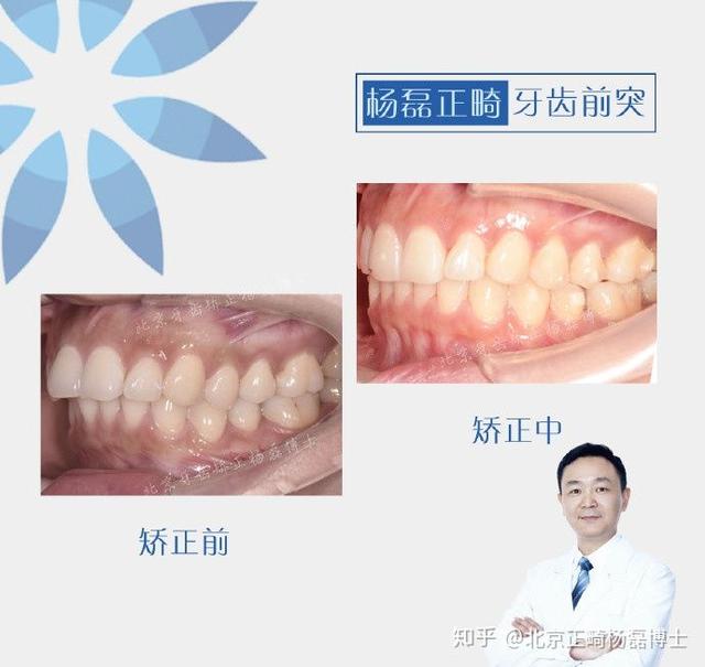 牙齿前突怎么矫正呢，上牙齿前突怎么矫正多少钱（不拔牙改善门牙前突）