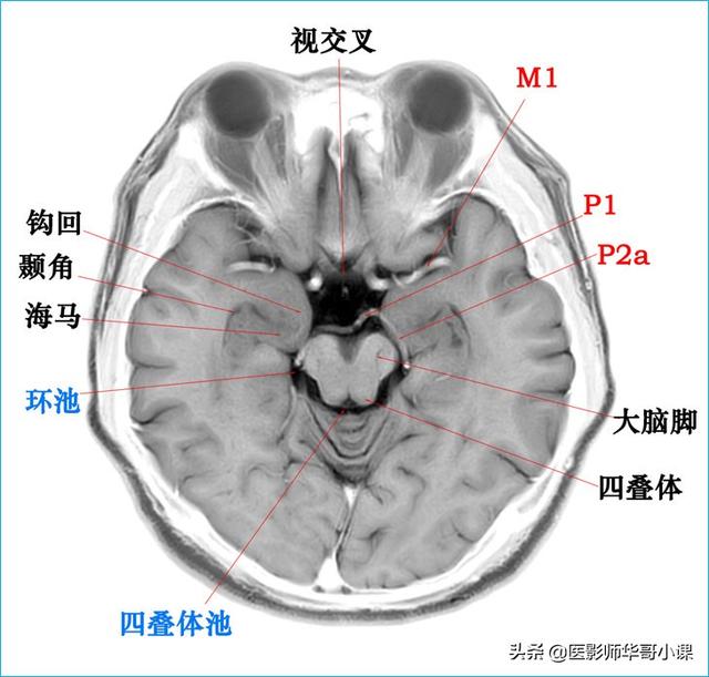 头颅ct解剖图，头部骨骼结构图（颅脑磁共振MRI解剖结构以及高清图谱）