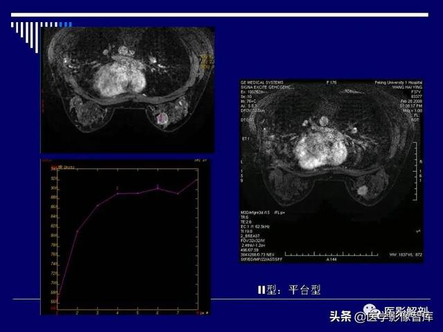 乳房解剖学基础知识，乳腺解剖及乳腺各病变影像诊断与鉴别