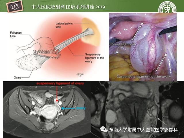 子宫颈影像解剖，子宫详细解剖及磁共振信号分析
