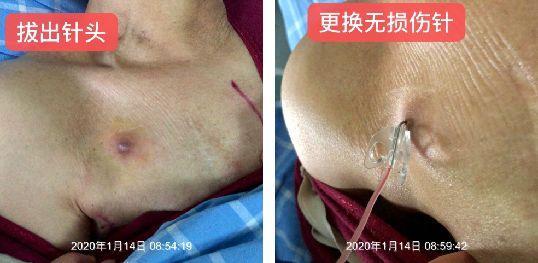 接口处充不进电弯着才充进电，充电 接口 插不进（输液港抽不出回血怎么办）