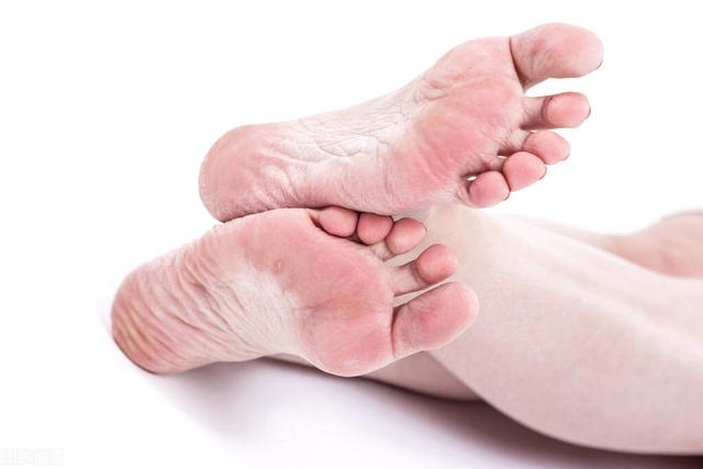 手开裂是什么原因，手裂是怎么回事（为什么有些人脚后跟总开裂）