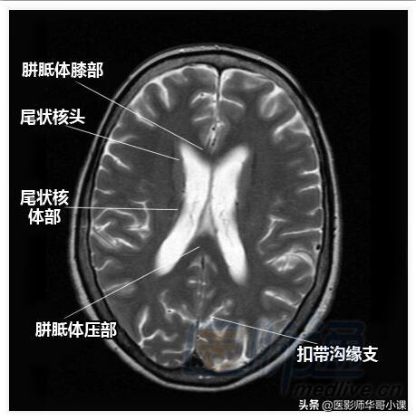 颅脑mri(头部MRI)插图(10)