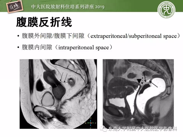 子宫颈影像解剖，子宫详细解剖及磁共振信号分析